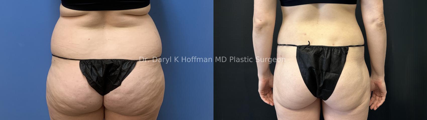 Liposuction Case 88 Before & After Back | San Jose & Palo Alto, CA | Daryl K. Hoffman, MD