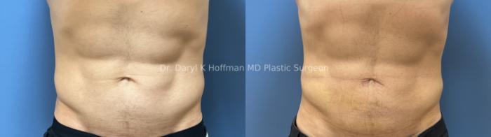 Liposuction Case 96 Before & After Front | San Jose & Palo Alto, CA | Daryl K. Hoffman, MD