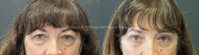 Blepharoplasty  Case 71 Before & After Front | San Jose & Palo Alto, CA | Daryl K. Hoffman, MD