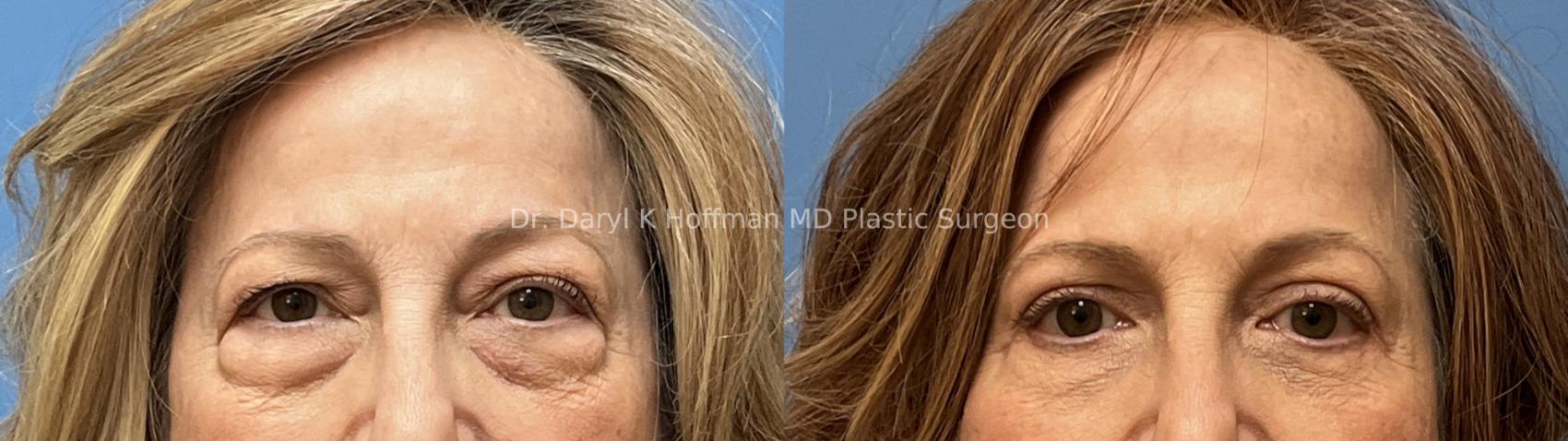 Blepharoplasty  Case 75 Before & After Front | San Jose & Palo Alto, CA | Daryl K. Hoffman, MD