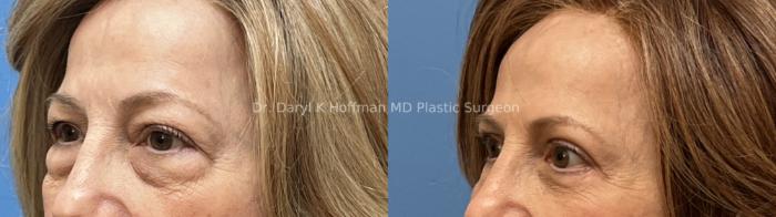 Blepharoplasty  Case 75 Before & After Left Oblique | San Jose & Palo Alto, CA | Daryl K. Hoffman, MD