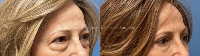 Blepharoplasty  Case 75 Before & After Right Oblique | San Jose & Palo Alto, CA | Daryl K. Hoffman, MD