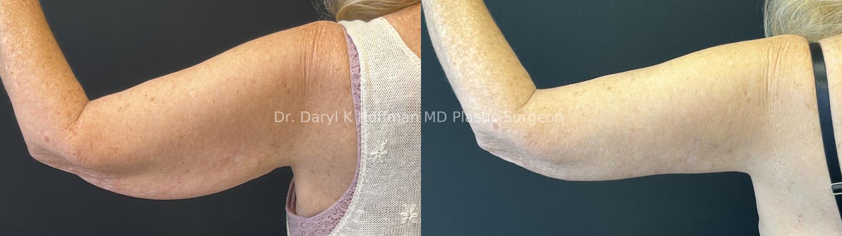 Brachioplasty(Arm Lift) Case 79 Before & After Left Side | San Jose & Palo Alto, CA | Daryl K. Hoffman, MD