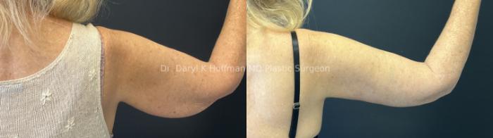 Brachioplasty(Arm Lift) Case 79 Before & After Right Side | San Jose & Palo Alto, CA | Daryl K. Hoffman, MD