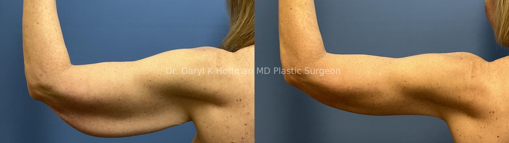Brachioplasty(Arm Lift) Case 92 Before & After Left back  | San Jose & Palo Alto, CA | Daryl K. Hoffman, MD