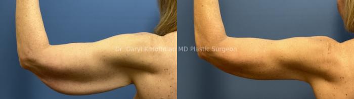 Brachioplasty(Arm Lift) Case 92 Before & After Left back  | San Jose & Palo Alto, CA | Daryl K. Hoffman, MD
