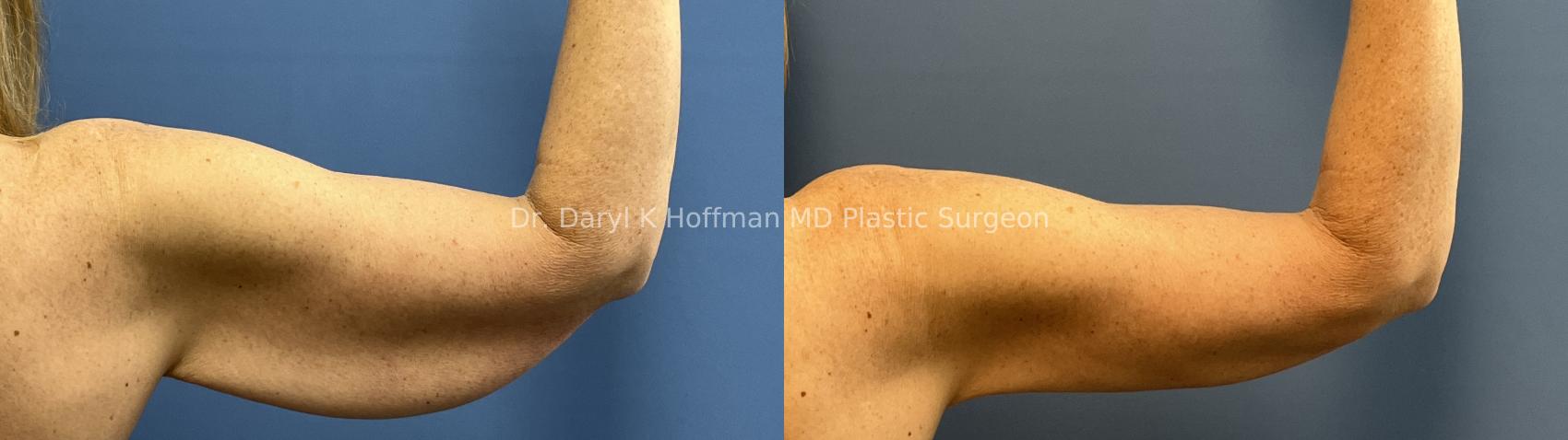 Brachioplasty(Arm Lift) Case 92 Before & After Right back  | San Jose & Palo Alto, CA | Daryl K. Hoffman, MD