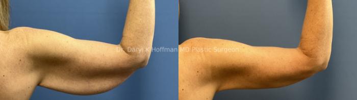 Brachioplasty(Arm Lift) Case 92 Before & After Right back  | San Jose & Palo Alto, CA | Daryl K. Hoffman, MD