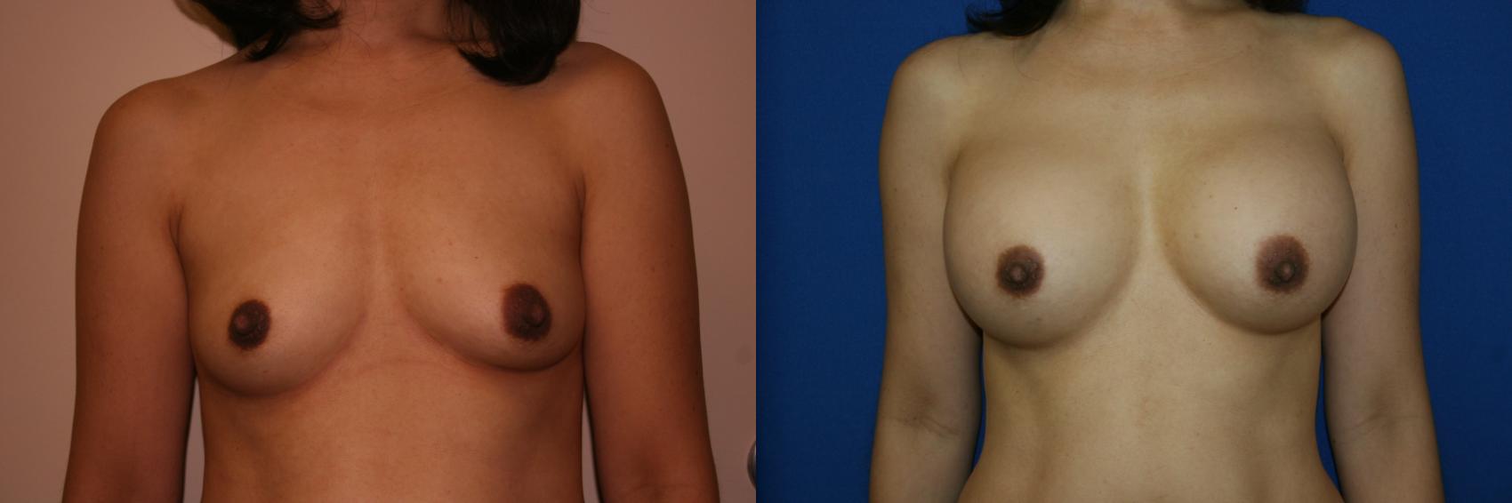 Breast Augmentation Case 10 Before & After View #1 | San Jose & Palo Alto, CA | Daryl K. Hoffman, MD
