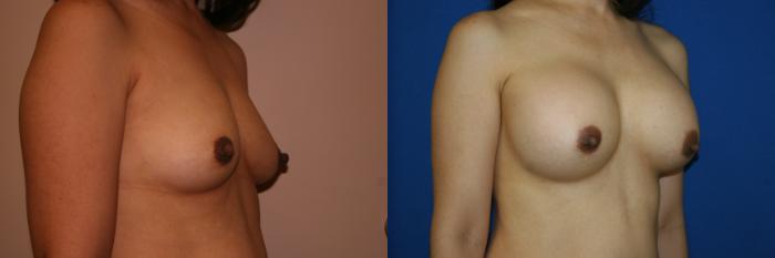 Breast Augmentation Case 10 Before & After View #2 | San Jose & Palo Alto, CA | Daryl K. Hoffman, MD