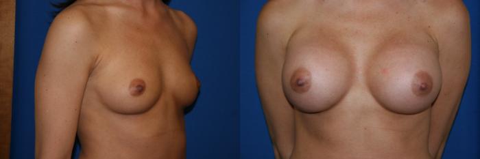 Breast Augmentation Case 11 Before & After View #1 | San Jose & Palo Alto, CA | Daryl K. Hoffman, MD