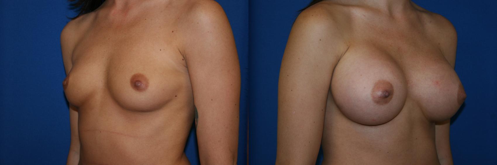 Breast Augmentation Case 11 Before & After View #2 | San Jose & Palo Alto, CA | Daryl K. Hoffman, MD