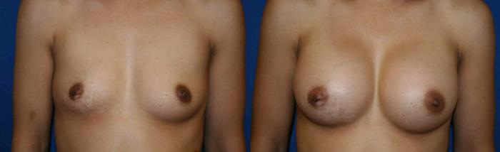 Breast Augmentation Case 12 Before & After View #1 | San Jose & Palo Alto, CA | Daryl K. Hoffman, MD