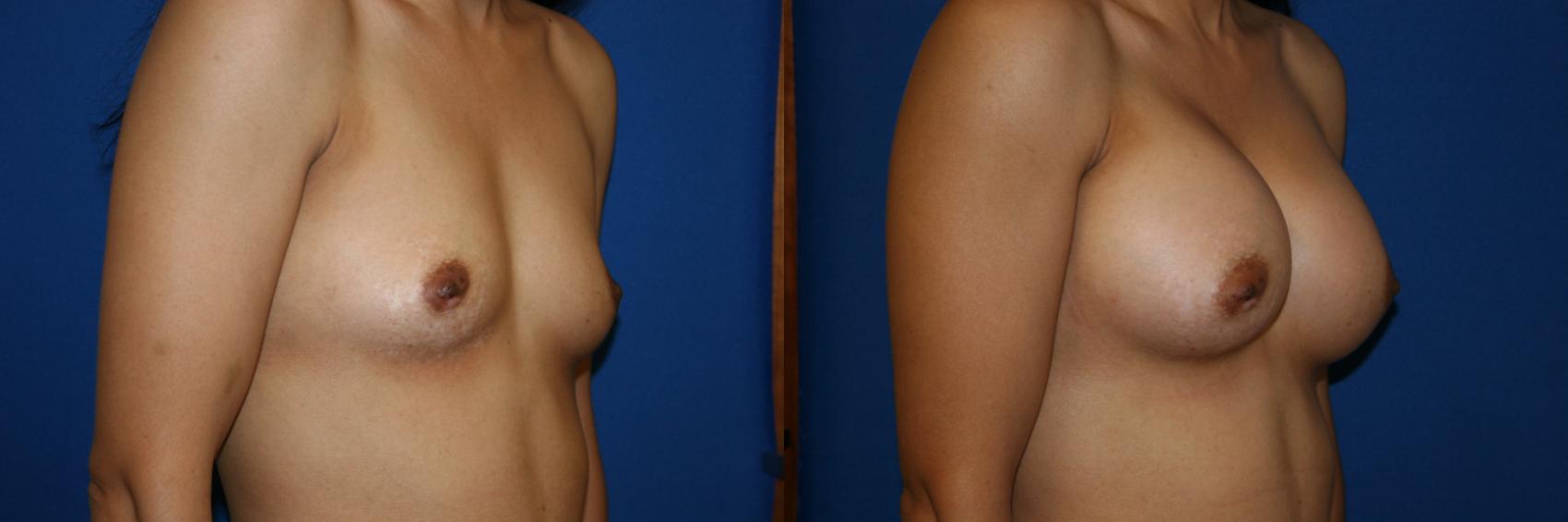 Breast Augmentation Case 12 Before & After View #2 | San Jose & Palo Alto, CA | Daryl K. Hoffman, MD