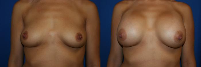 Breast Augmentation Case 13 Before & After View #1 | San Jose & Palo Alto, CA | Daryl K. Hoffman, MD