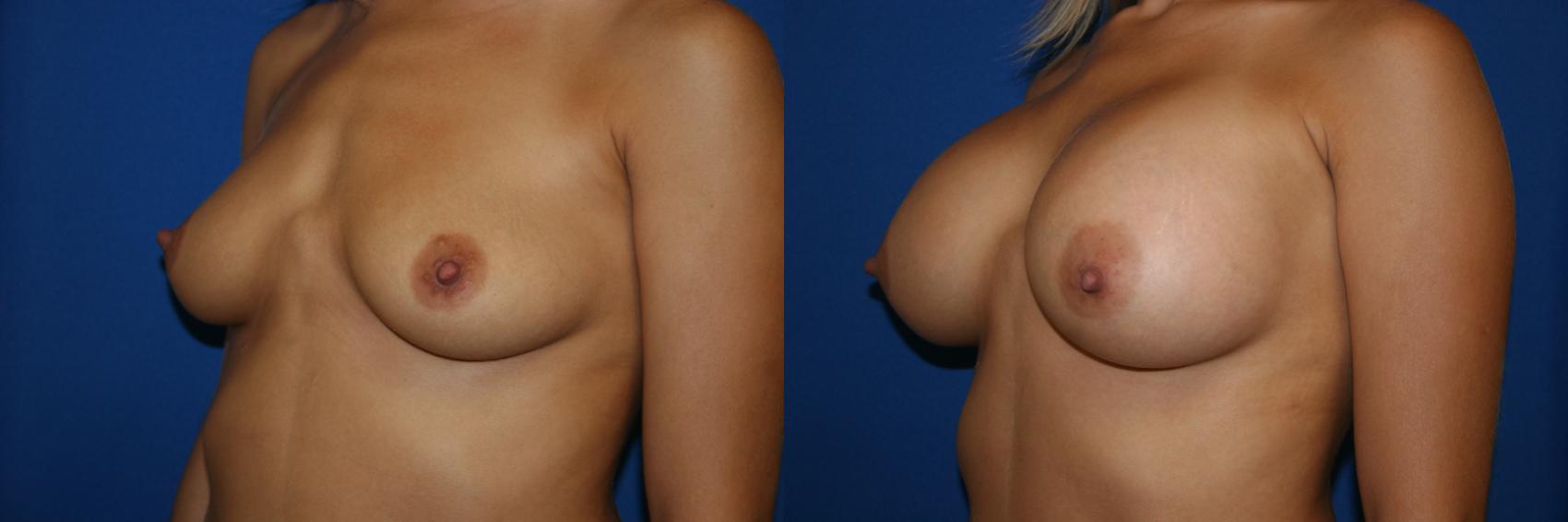 Breast Augmentation Case 13 Before & After View #2 | San Jose & Palo Alto, CA | Daryl K. Hoffman, MD