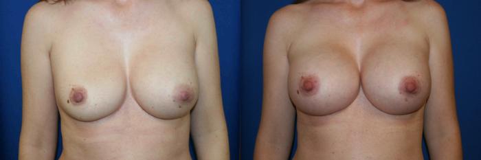 Breast Augmentation Case 14 Before & After View #1 | San Jose & Palo Alto, CA | Daryl K. Hoffman, MD