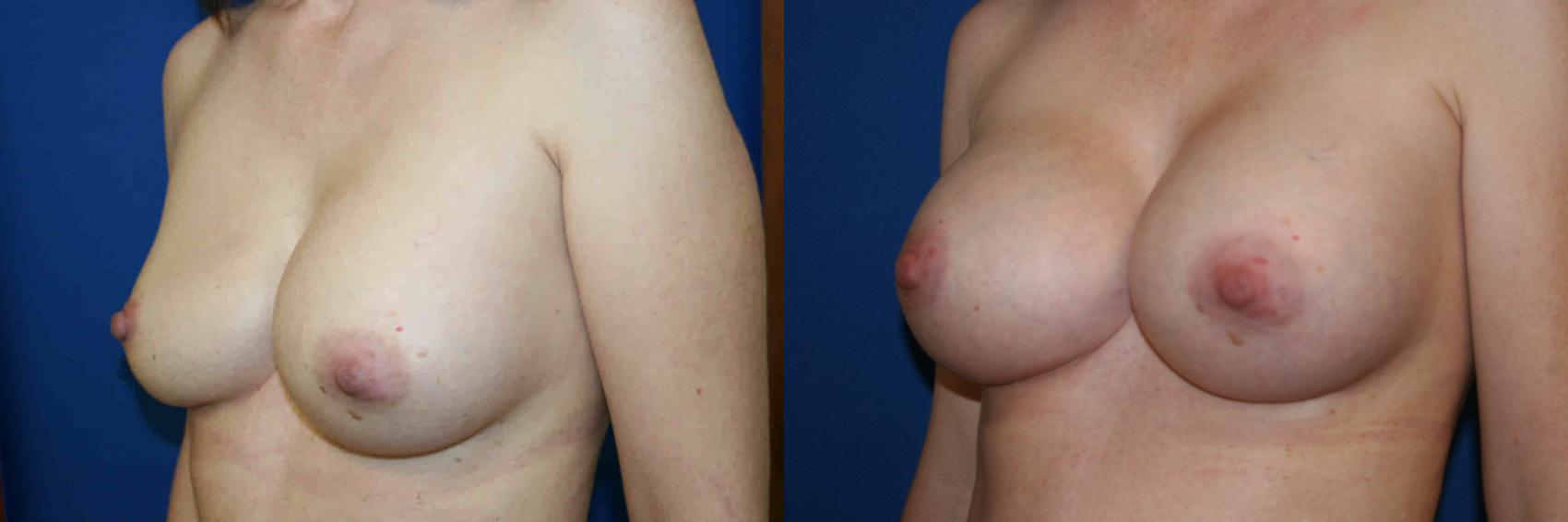 Breast Augmentation Case 14 Before & After View #2 | San Jose & Palo Alto, CA | Daryl K. Hoffman, MD