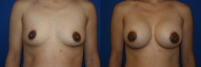 Breast Augmentation Case 15 Before & After View #1 | San Jose & Palo Alto, CA | Daryl K. Hoffman, MD