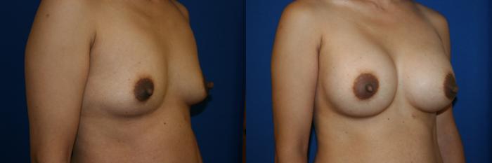 Breast Augmentation Case 15 Before & After View #2 | San Jose & Palo Alto, CA | Daryl K. Hoffman, MD