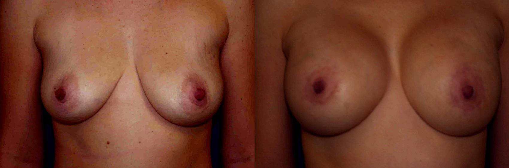 Breast Augmentation Case 3 Before & After View #1 | San Jose & Palo Alto, CA | Daryl K. Hoffman, MD