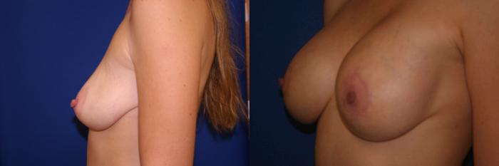Breast Augmentation Case 3 Before & After View #2 | San Jose & Palo Alto, CA | Daryl K. Hoffman, MD