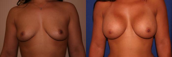 Breast Augmentation Case 4 Before & After View #1 | San Jose & Palo Alto, CA | Daryl K. Hoffman, MD