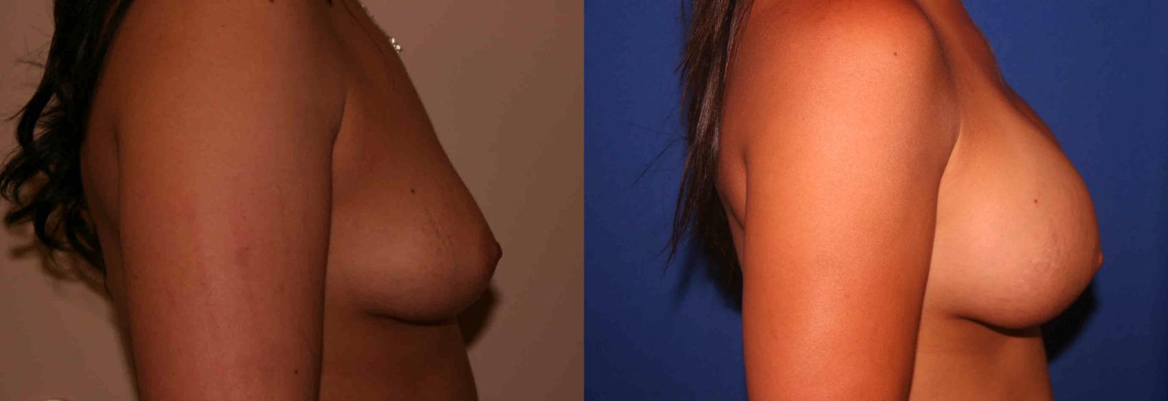 Breast Augmentation Case 4 Before & After View #2 | San Jose & Palo Alto, CA | Daryl K. Hoffman, MD