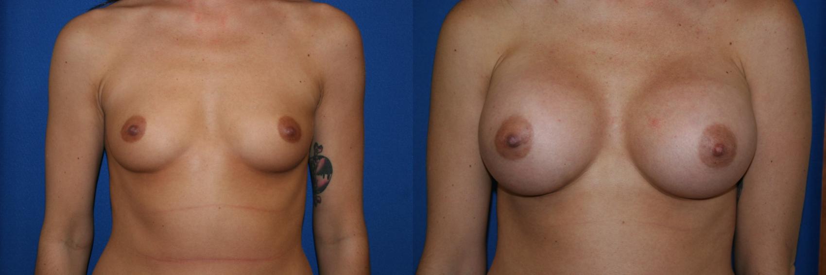Breast Augmentation Case 45 Before & After View #1 | San Jose & Palo Alto, CA | Daryl K. Hoffman, MD