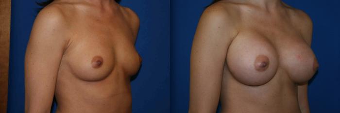 Breast Augmentation Case 45 Before & After View #2 | San Jose & Palo Alto, CA | Daryl K. Hoffman, MD
