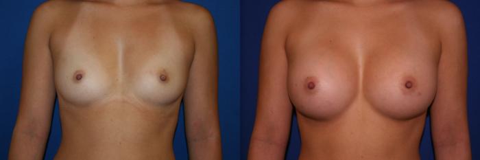 Breast Augmentation Case 46 Before & After View #1 | San Jose & Palo Alto, CA | Daryl K. Hoffman, MD