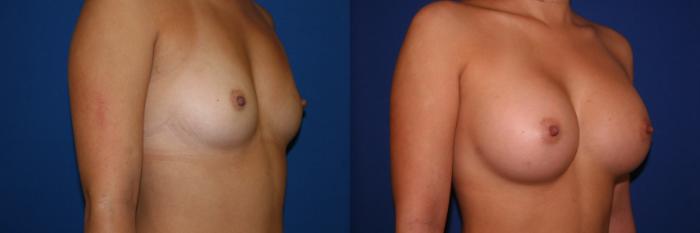 Breast Augmentation Case 46 Before & After View #2 | San Jose & Palo Alto, CA | Daryl K. Hoffman, MD