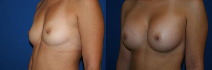 Breast Augmentation Case 46 Before & After View #3 | San Jose & Palo Alto, CA | Daryl K. Hoffman, MD