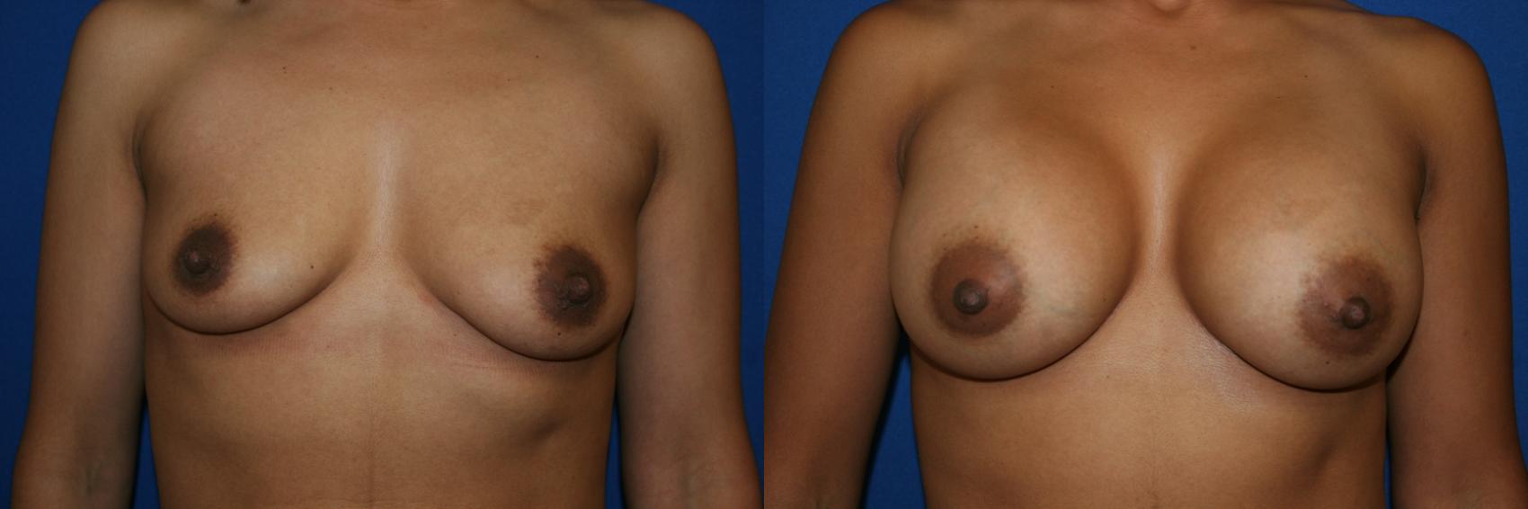 Breast Augmentation Case 47 Before & After View #1 | San Jose & Palo Alto, CA | Daryl K. Hoffman, MD