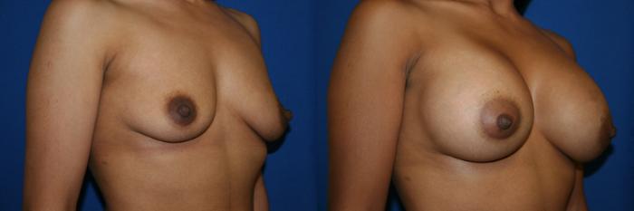 Breast Augmentation Case 47 Before & After View #2 | San Jose & Palo Alto, CA | Daryl K. Hoffman, MD