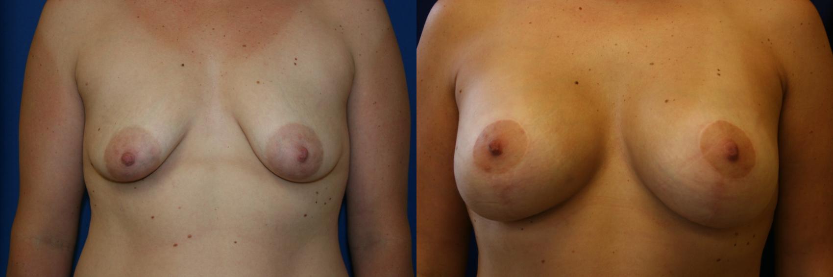 Breast Augmentation Case 48 Before & After View #1 | San Jose & Palo Alto, CA | Daryl K. Hoffman, MD