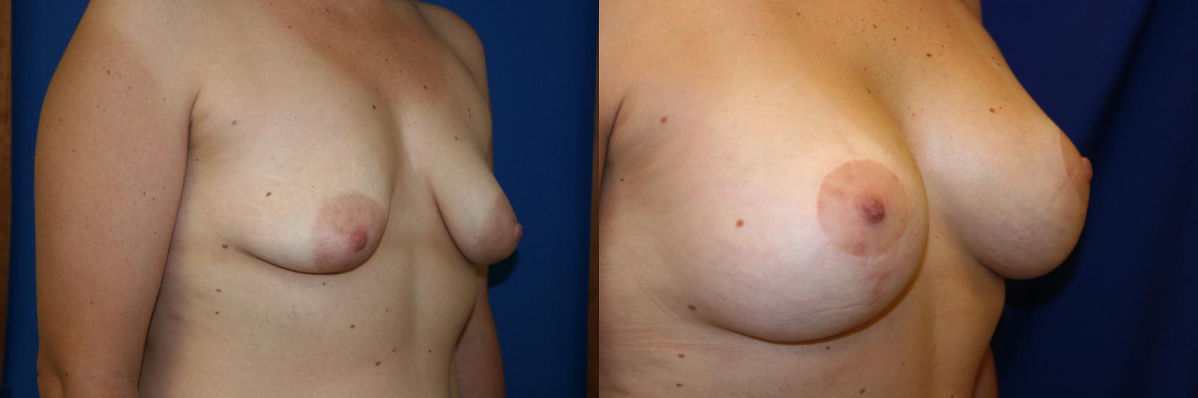 Breast Augmentation Case 48 Before & After View #2 | San Jose & Palo Alto, CA | Daryl K. Hoffman, MD