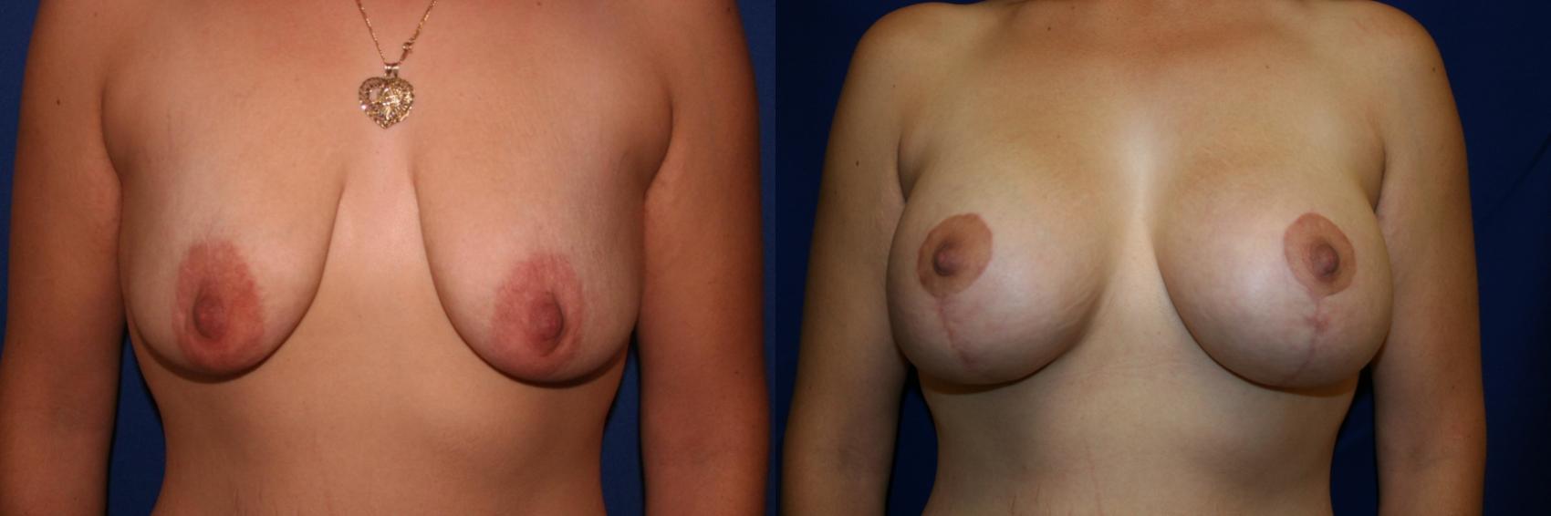 Breast Augmentation Case 49 Before & After View #1 | San Jose & Palo Alto, CA | Daryl K. Hoffman, MD