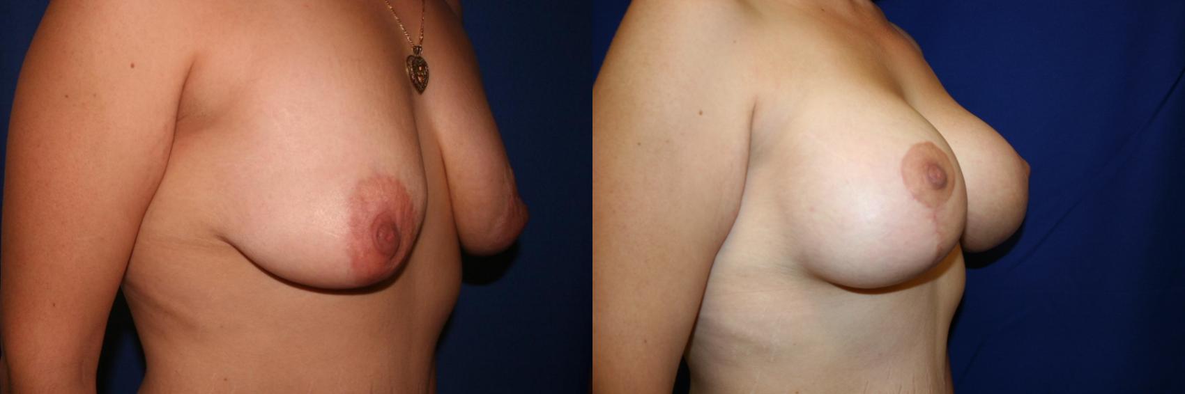 Breast Augmentation Case 49 Before & After View #2 | San Jose & Palo Alto, CA | Daryl K. Hoffman, MD