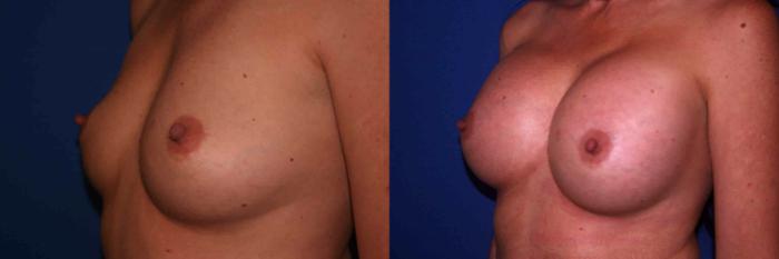 Breast Augmentation Case 5 Before & After View #1 | San Jose & Palo Alto, CA | Daryl K. Hoffman, MD