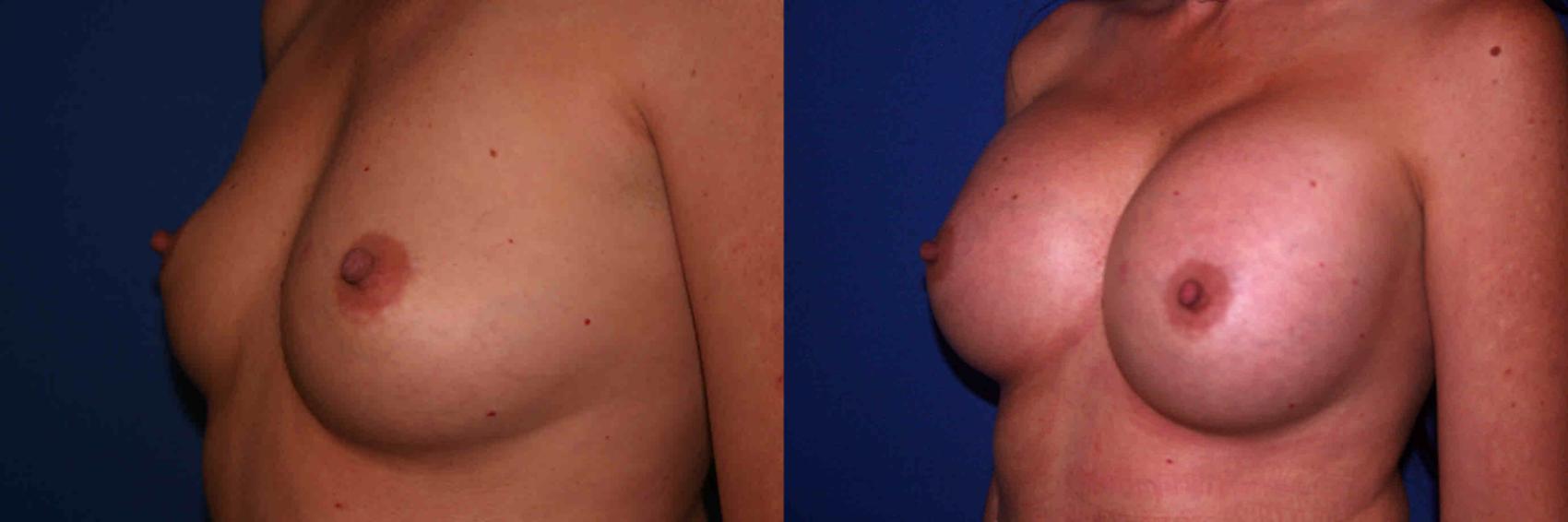 Breast Augmentation Case 5 Before & After View #2 | San Jose & Palo Alto, CA | Daryl K. Hoffman, MD