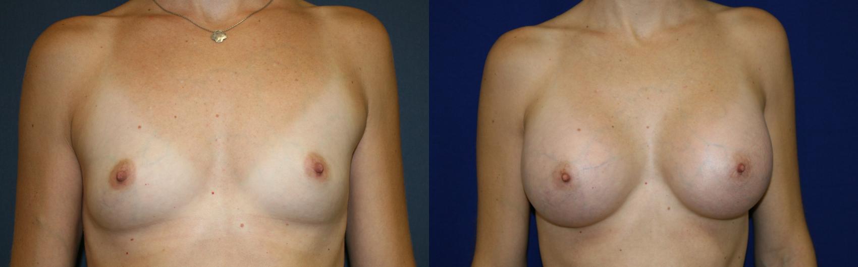 Breast Augmentation Case 50 Before & After View #2 | San Jose & Palo Alto, CA | Daryl K. Hoffman, MD