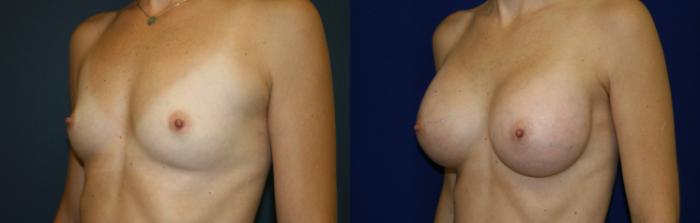 Breast Augmentation Case 50 Before & After View #3 | San Jose & Palo Alto, CA | Daryl K. Hoffman, MD