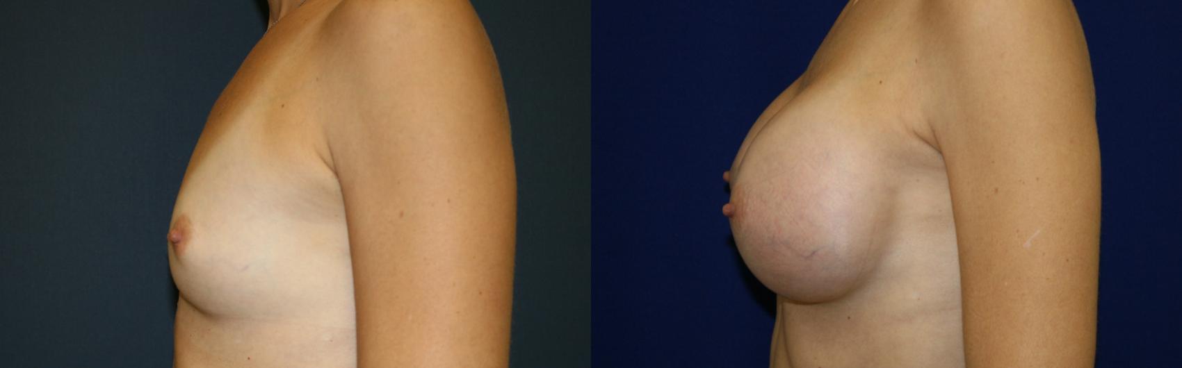 Breast Augmentation Case 50 Before & After View #4 | San Jose & Palo Alto, CA | Daryl K. Hoffman, MD