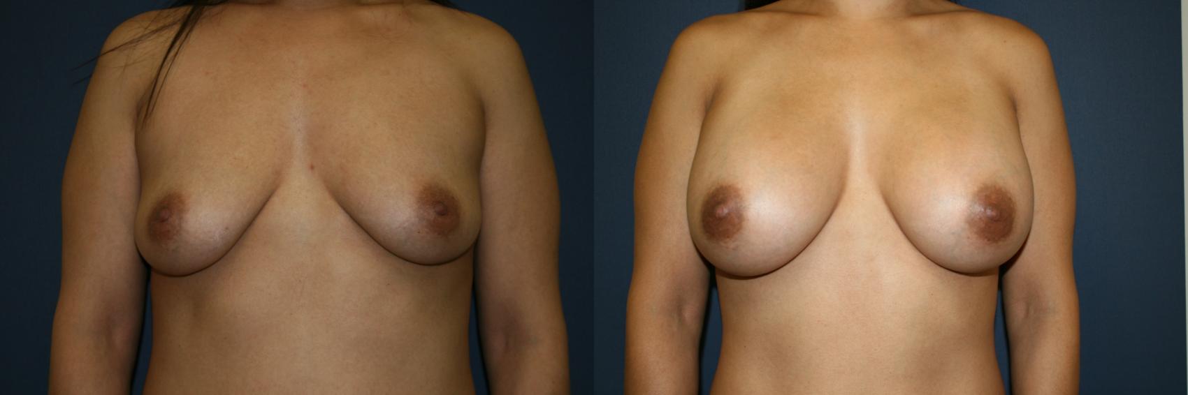 Breast Augmentation Case 51 Before & After View #1 | San Jose & Palo Alto, CA | Daryl K. Hoffman, MD