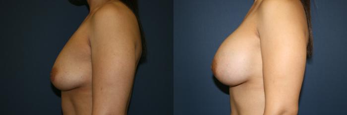 Breast Augmentation Case 51 Before & After View #2 | San Jose & Palo Alto, CA | Daryl K. Hoffman, MD