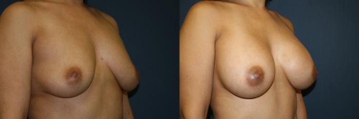 Breast Augmentation Case 51 Before & After View #3 | San Jose & Palo Alto, CA | Daryl K. Hoffman, MD