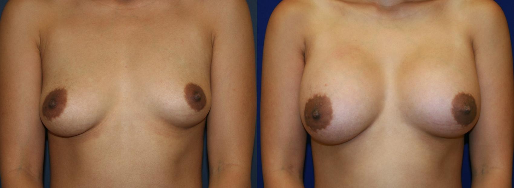 Breast Augmentation Case 52 Before & After View #1 | San Jose & Palo Alto, CA | Daryl K. Hoffman, MD