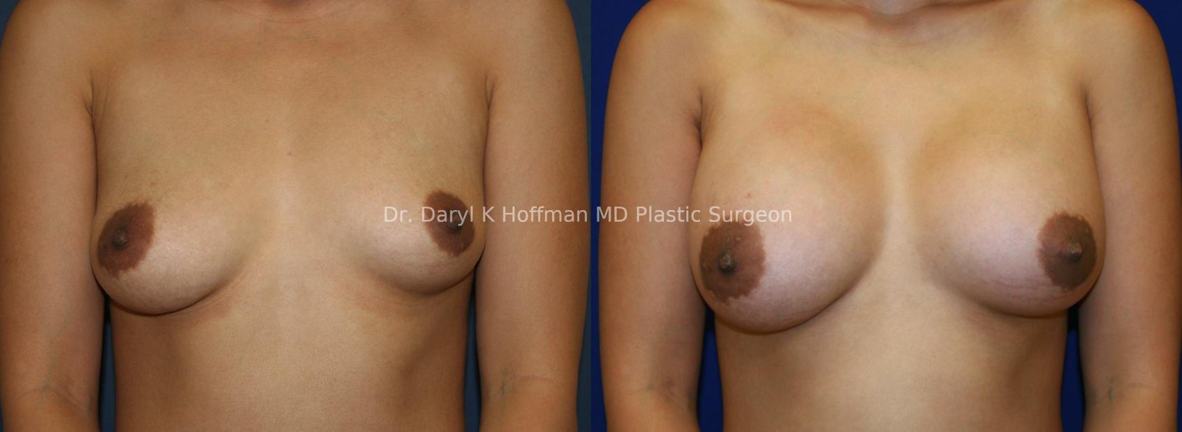 Breast Augmentation Case 52 Before & After View #1 | San Jose & Palo Alto, CA | Daryl K. Hoffman, MD