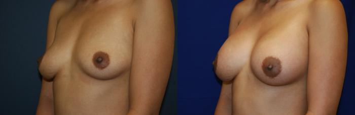Breast Augmentation Case 52 Before & After View #2 | San Jose & Palo Alto, CA | Daryl K. Hoffman, MD